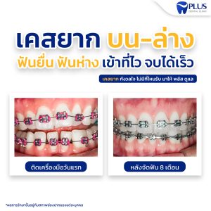 จัดฟัน เคสบน-ล่าง ยื่นห่าง