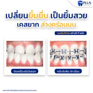 จัดฟัน เคสล่างคร่อมบน-1