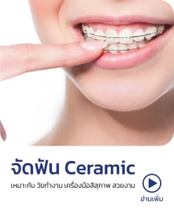 จัดฟันเซรามิก