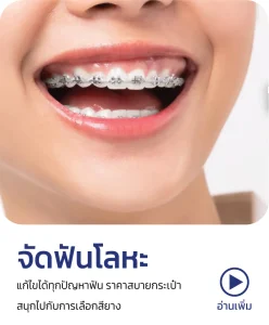 จัดฟันโลหะ