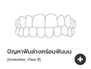 ฟันล่างคร่อมบน