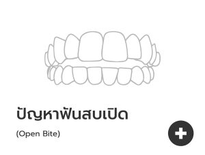 ฟันสบเปิด