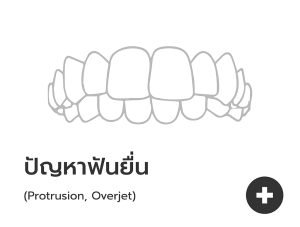 ฟันยื่น