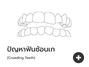 ฟันซ้อนเก