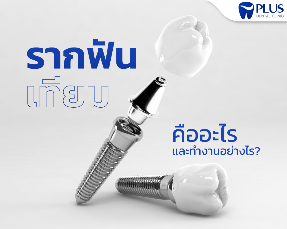 รากเทียม