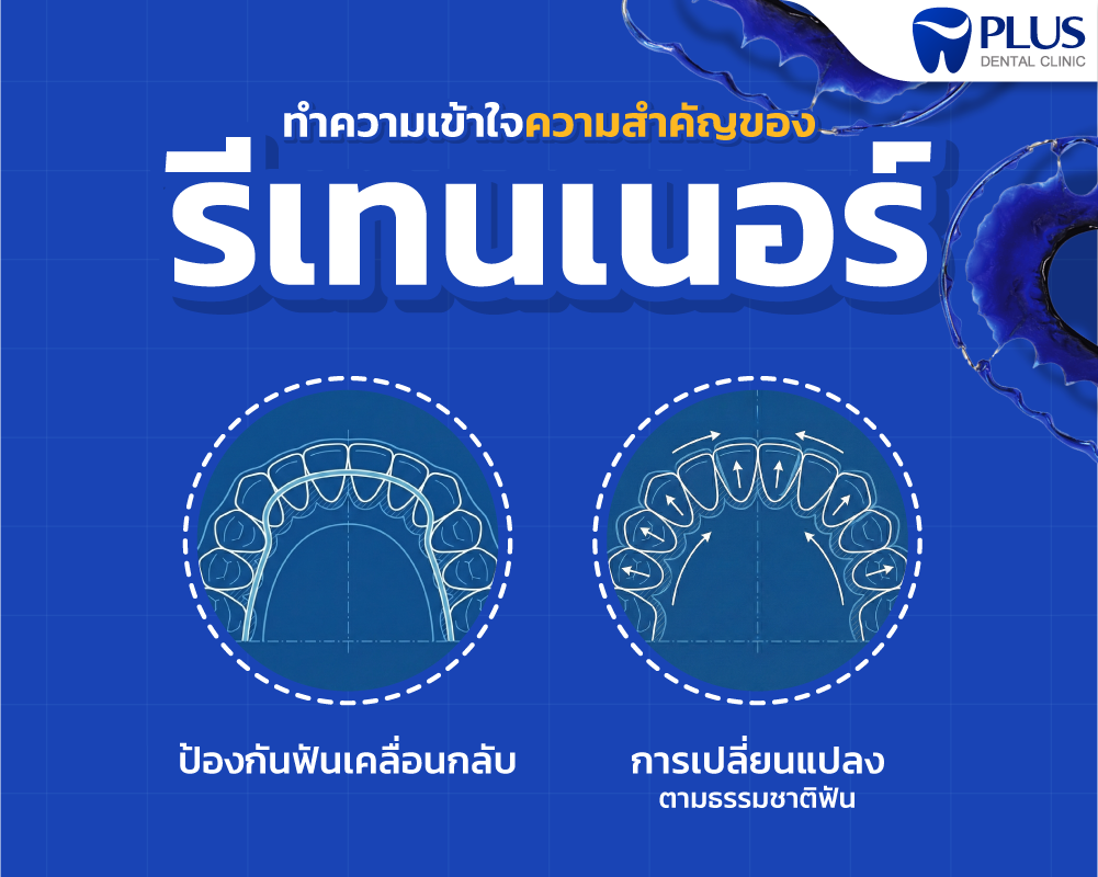รีเทนเนอร์หลังจัดฟัน